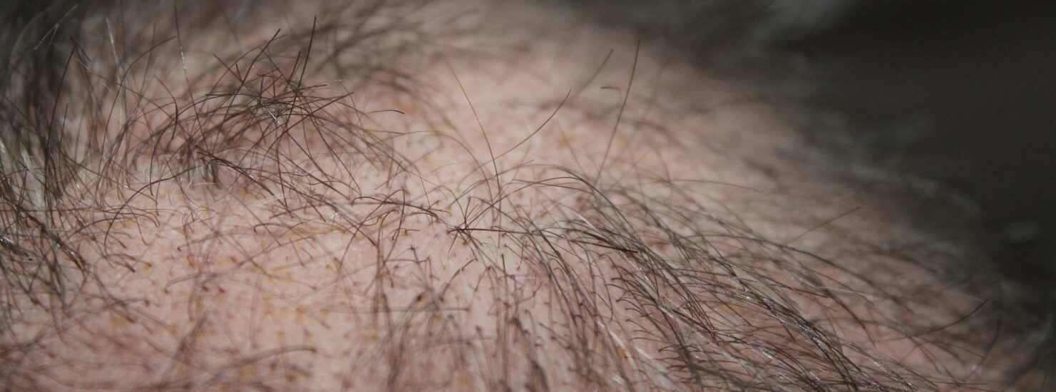 Natural Treatments To Stop And Reverse Hair Loss